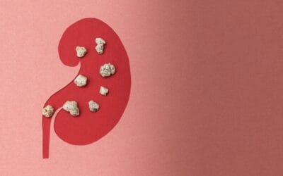 Understanding Kidney Stones: Causes, Symptoms, Treatment, and Alternative Therapies